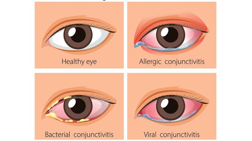 Signs of Eyelash Glue Allergic Reactions | Winlash Symptoms of eyelash glue allergic reactions and solutions | Winlash